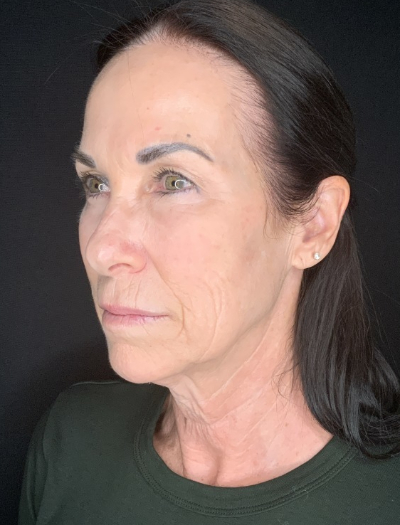 Patient #12585: In-office facelift with Fat Injections, Lip Lift & Perioral Ablative Laser Before Image