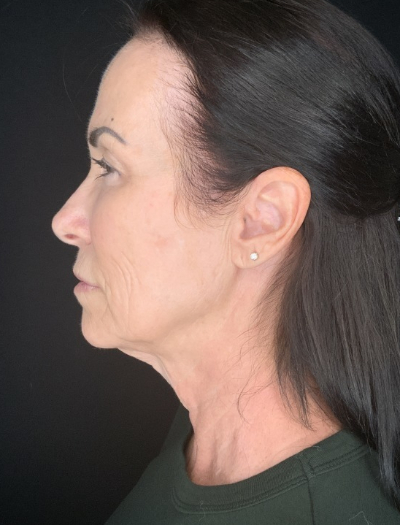 Patient #12585: In-office facelift with Fat Injections, Lip Lift & Perioral Ablative Laser Before Image