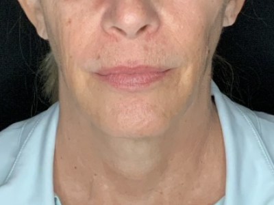 Patient #36789: In-Office Facelift with Fat Injections Before Image