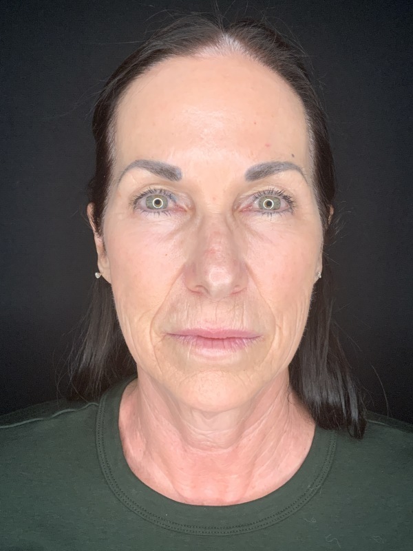 Patient #12585: In-Office Facelift with Fat Injections, Lip Lift, & Perioral Ablative Laser [DUPLICATE] Before Image