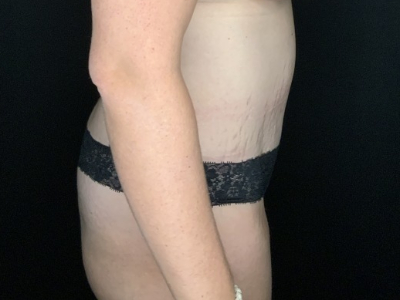 Patient #93147: Tummy Tuck with Liposuction to Flanks & Hips After Image
