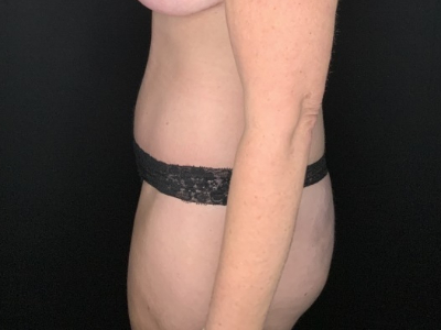 Patient #31458: Tummy Tuck with Liposuction to Flanks After Image
