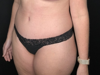 Patient #31458: Tummy Tuck with Liposuction to Flanks After Image