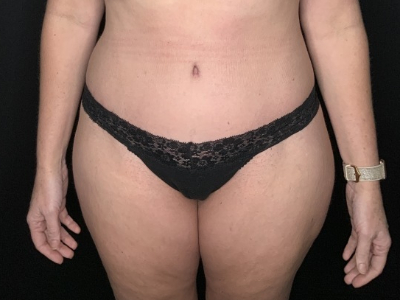 Patient #31458: Tummy Tuck with Liposuction to Flanks After Image