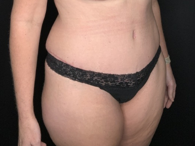 Patient #31458: Tummy Tuck with Liposuction to Flanks After Image
