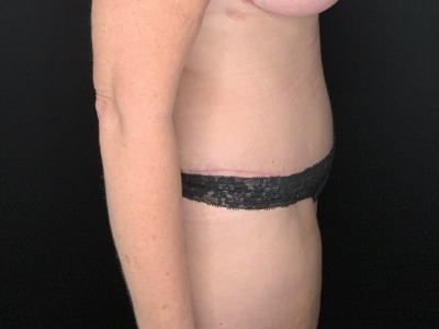 Patient #31458: Tummy Tuck with Liposuction to Flanks After Image