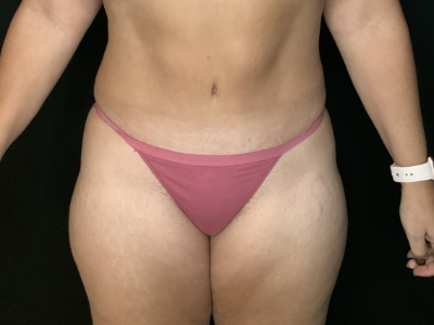 Patient #45745: Tummy Tuck with Liposuction to Flanks After Image