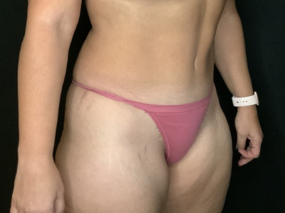 Patient #45745: Tummy Tuck with Liposuction to Flanks After Image