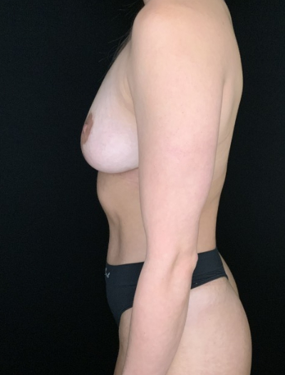 Patient #56985 Mommy Makeover After Image