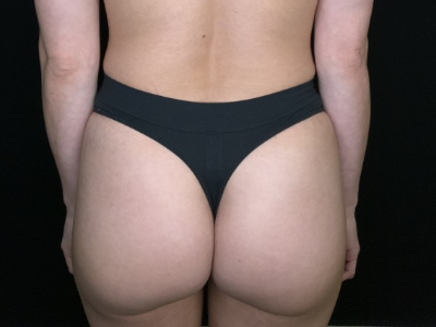 Patient #56985 Mommy Makeover After Image