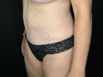 Patient #93147: Tummy Tuck with Liposuction to Flanks & Hips After Image