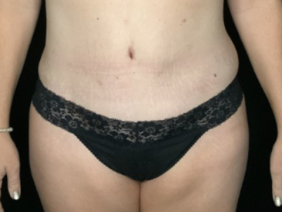 Patient #93147: Tummy Tuck with Liposuction to Flanks & Hips After Image