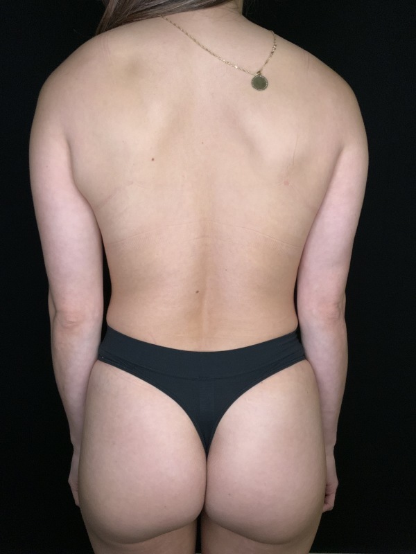 Patient #56985 Mommy Makeover After Image