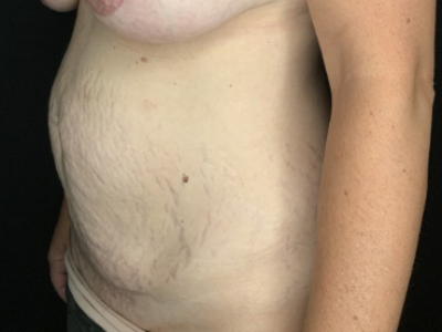 Patient #93147: Tummy Tuck with Liposuction to Flanks & Hips Before Image