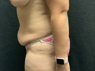 Patient #45745: Tummy Tuck with Liposuction to Flanks Before Image
