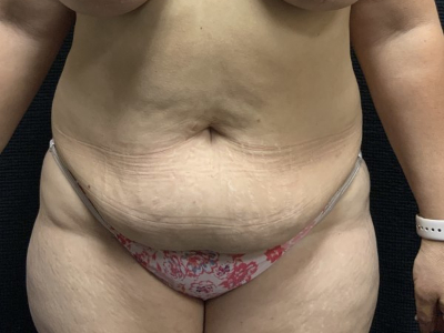 Patient #45745: Tummy Tuck with Liposuction to Flanks Before Image