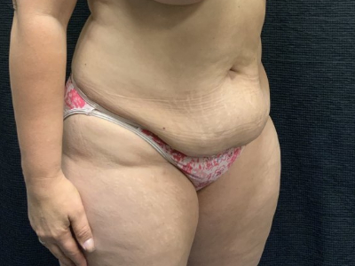 Patient #45745: Tummy Tuck with Liposuction to Flanks Before Image
