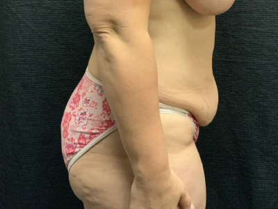 Patient #45745: Tummy Tuck with Liposuction to Flanks Before Image