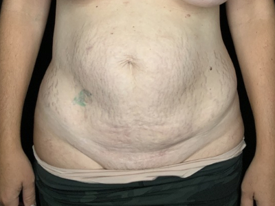 Patient #93147: Tummy Tuck with Liposuction to Flanks & Hips Before Image
