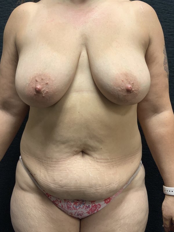 Patient #45745: Mommy Makeover with Liposuction Before Image