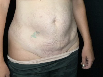 Patient #93147: Tummy Tuck with Liposuction to Flanks & Hips Before Image