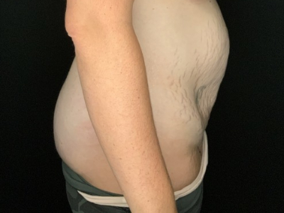 Patient #93147: Tummy Tuck with Liposuction to Flanks & Hips Before Image