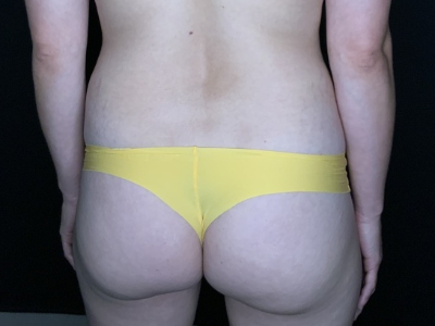 Patient #56985 Mommy Makeover Before Image