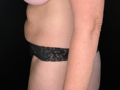 Patient #31458: Tummy Tuck with Liposuction to Flanks Before Image