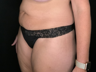 Patient #31458: Tummy Tuck with Liposuction to Flanks Before Image