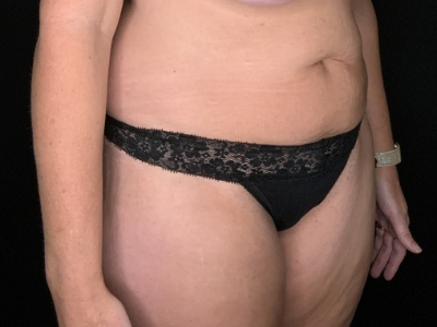 Patient #31458: Tummy Tuck with Liposuction to Flanks Before Image