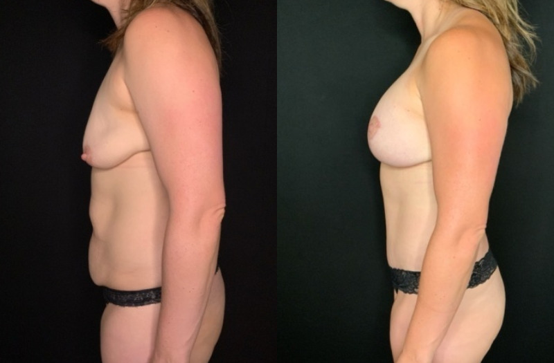 Patient #92468: Mommy Makeover Combine Image