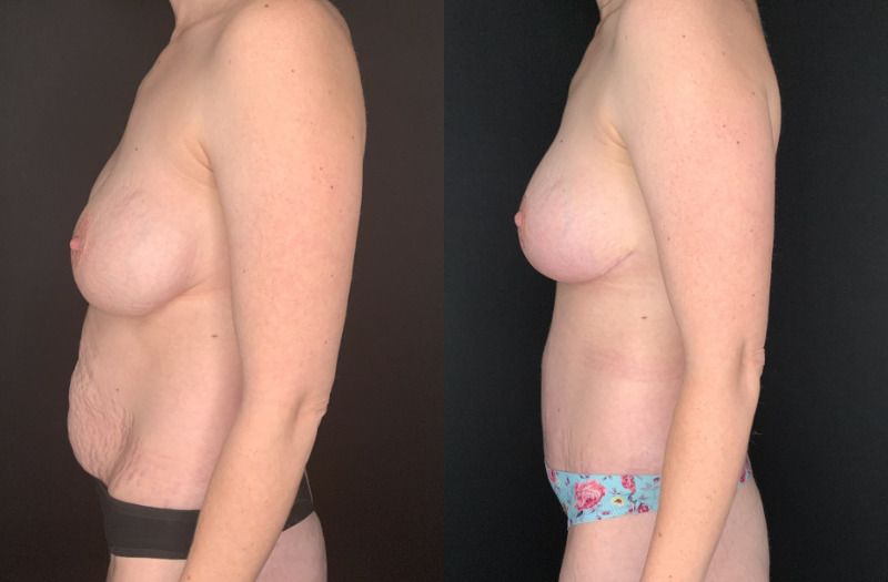 Patient #54673: Mommy Makeover Combine Image