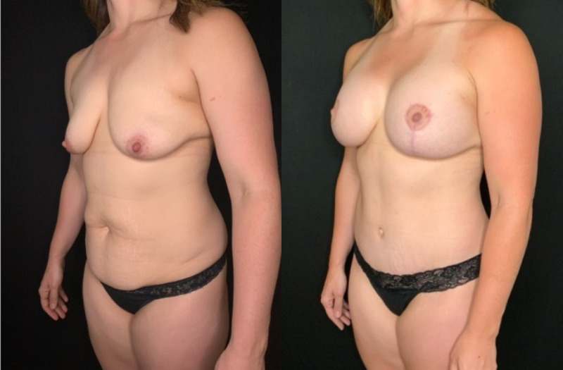 Patient #92468: Mommy Makeover Combine Image