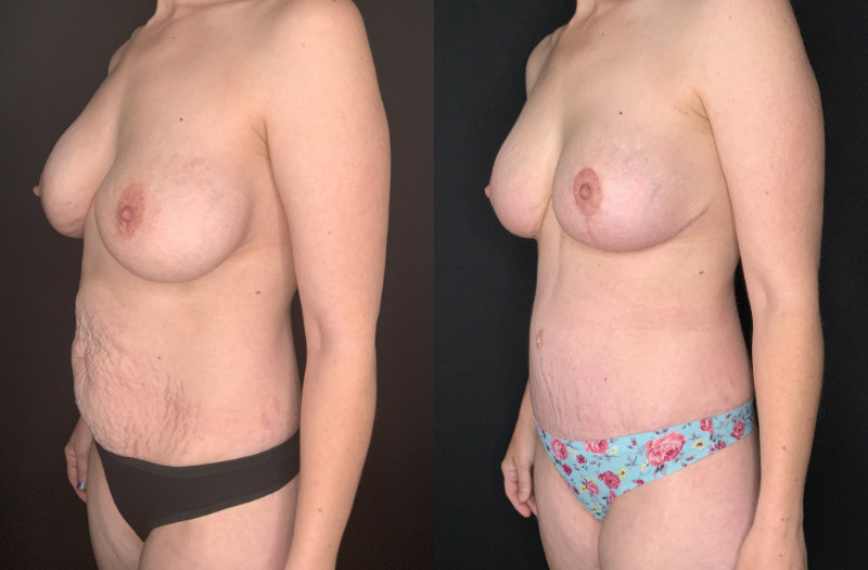 Patient #54673: Mommy Makeover Combine Image