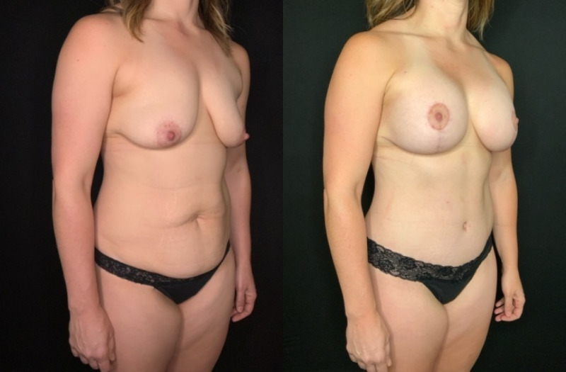 Patient #92468: Mommy Makeover Combine Image