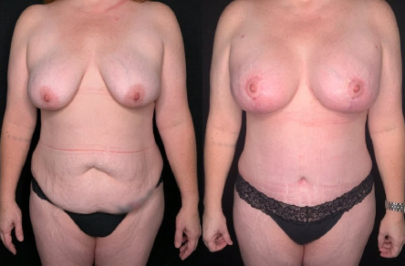 Patient #59874: Mommy Makeover Combine Image
