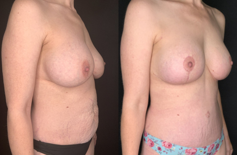 Patient #54673: Mommy Makeover Combine Image