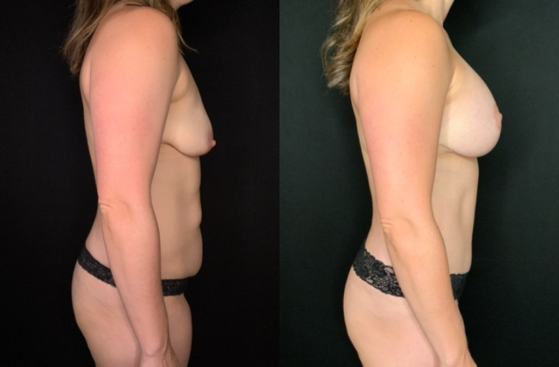 Patient #92468: Mommy Makeover Combine Image