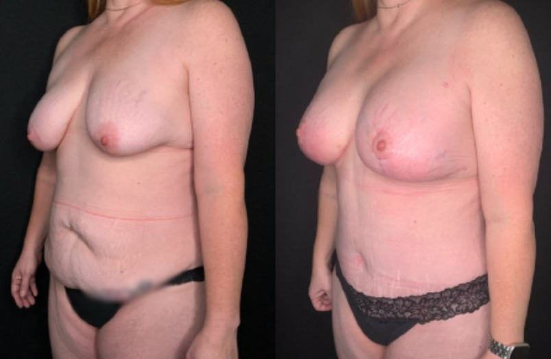 Patient #59874: Mommy Makeover Combine Image