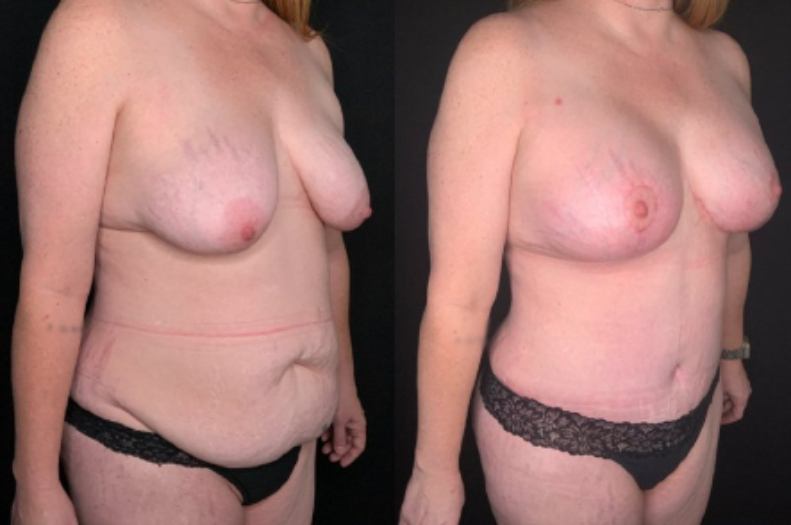 Patient #59874: Mommy Makeover Combine Image