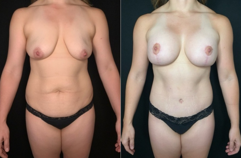 Patient #92468: Mommy Makeover Combine Image