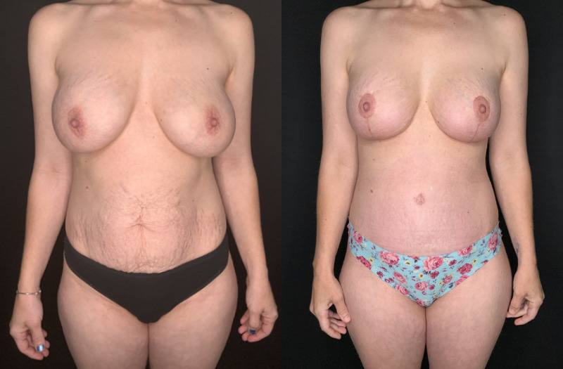 Patient #54673: Mommy Makeover Combine Image