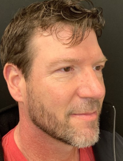 Patient #12485: IPL to Nose and Cheeks After Image