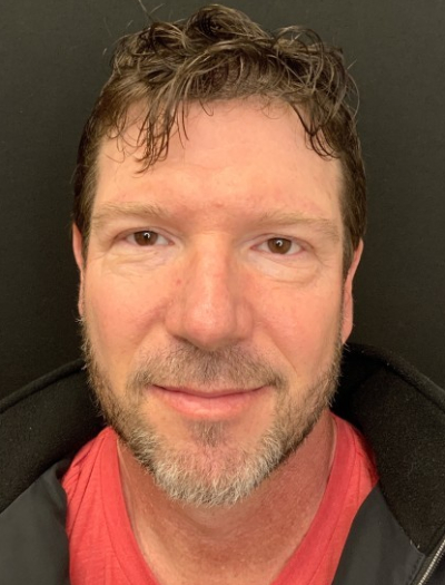 Patient #12485: IPL to Nose and Cheeks After Image