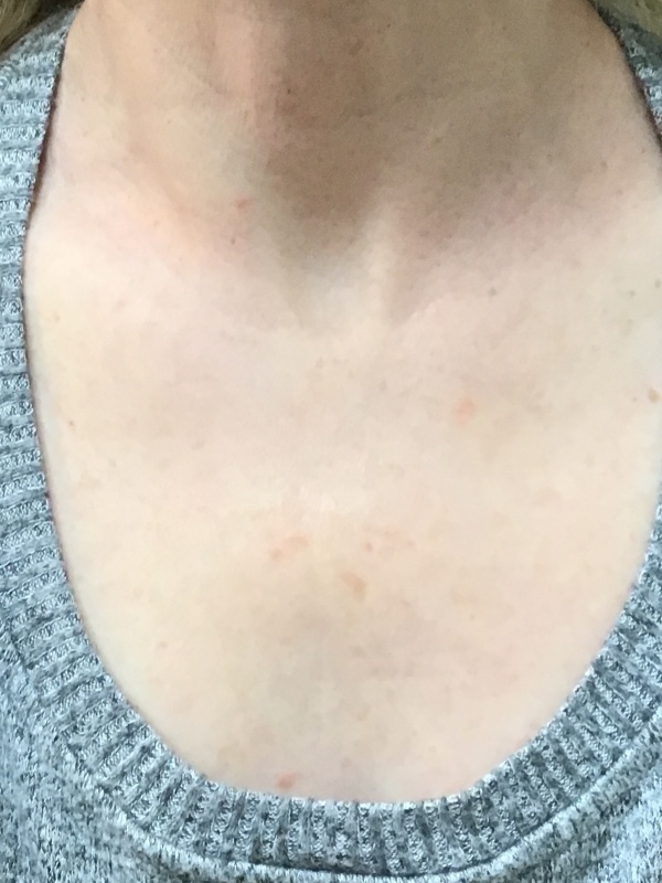 Patient #32569: IPL to Chest After Image