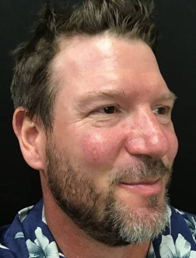 Patient #12485: IPL to Nose and Cheeks Before Image