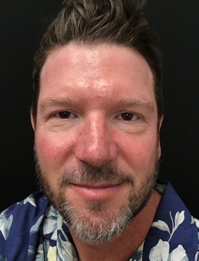 Patient #12485: IPL to Nose and Cheeks Before Image