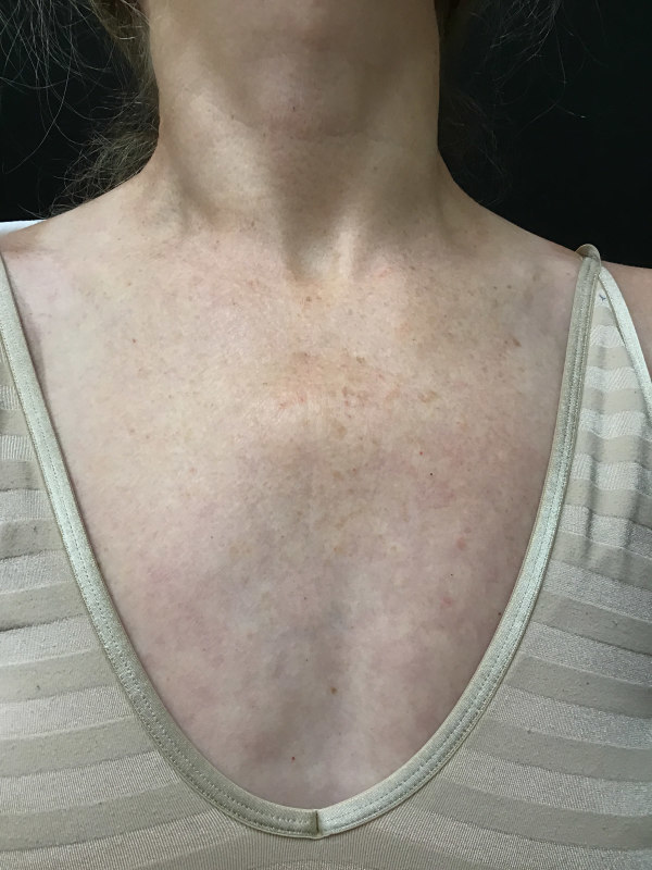 Patient #32569: IPL to Chest Before Image