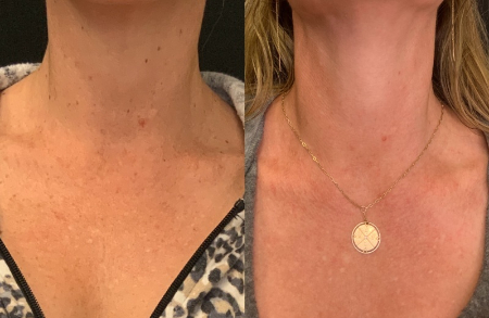 Patient #85423: IPL & Resurfacing to Neck and Chest Combine Image