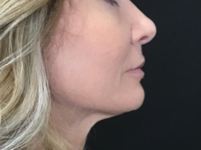 Patient #93804 – Ablative Laser After Image